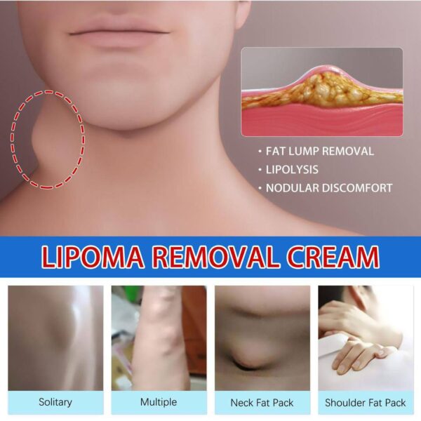 LIPOMA REMOVAL/RELIEF CREAM