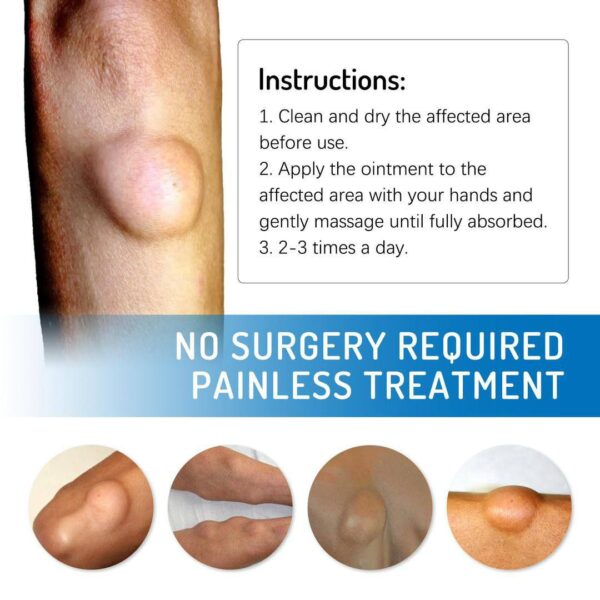 LIPOMA REMOVAL/RELIEF CREAM