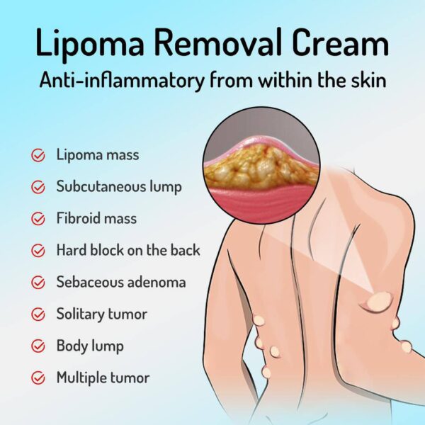LIPOMA REMOVAL/RELIEF CREAM