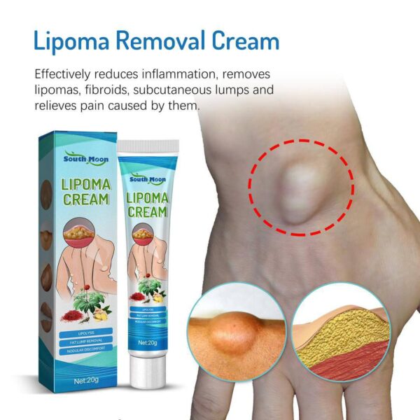 LIPOMA REMOVAL/RELIEF CREAM